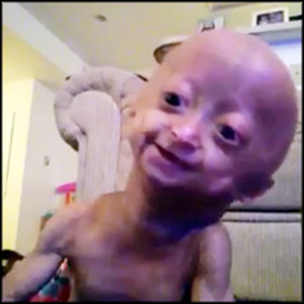 Little Girl with Progeria Sings Jesus Loves Me