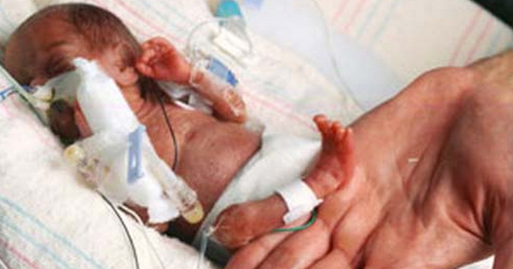 World's Smallest Baby Was Born - a True Miracle of God