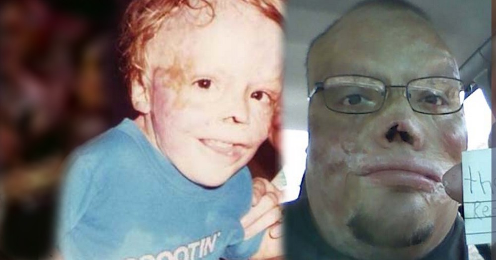 He Wasn't Supposed to Survive, but This Burn Victim Inspires. WOW.