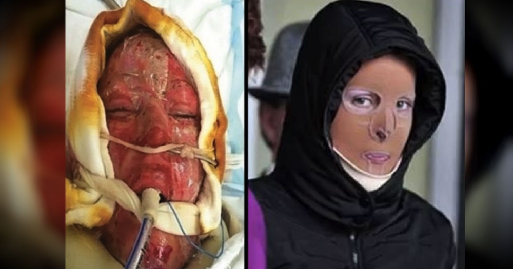 A Jealous Woman Set Her On Fire. After 2 Years, See Her Miraculous Recovery!