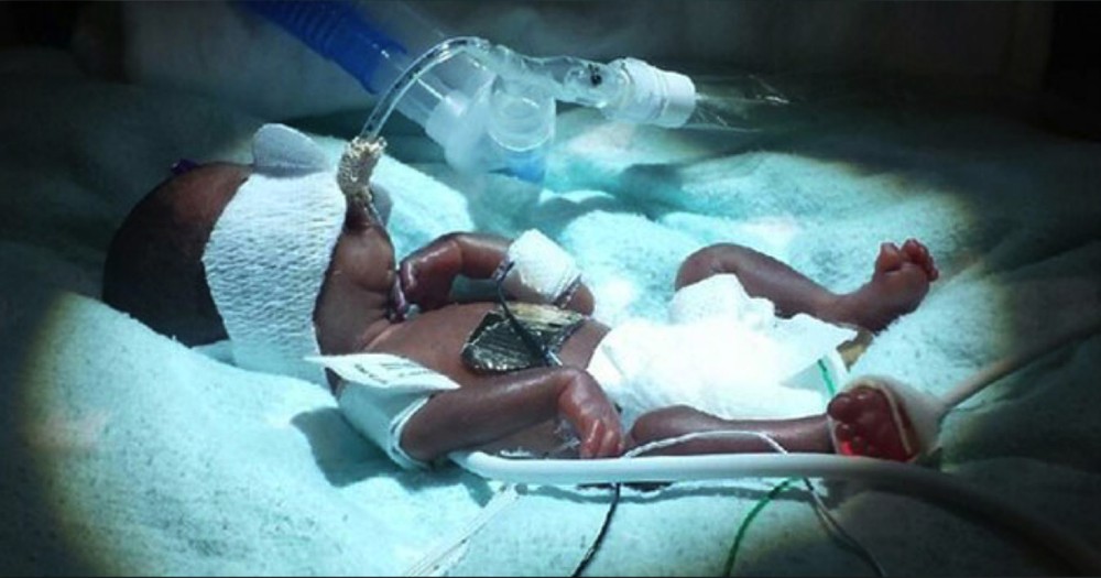 Born 3 Months Early, This Baby Girl Is One Of God's Tiniest MIRACLES!