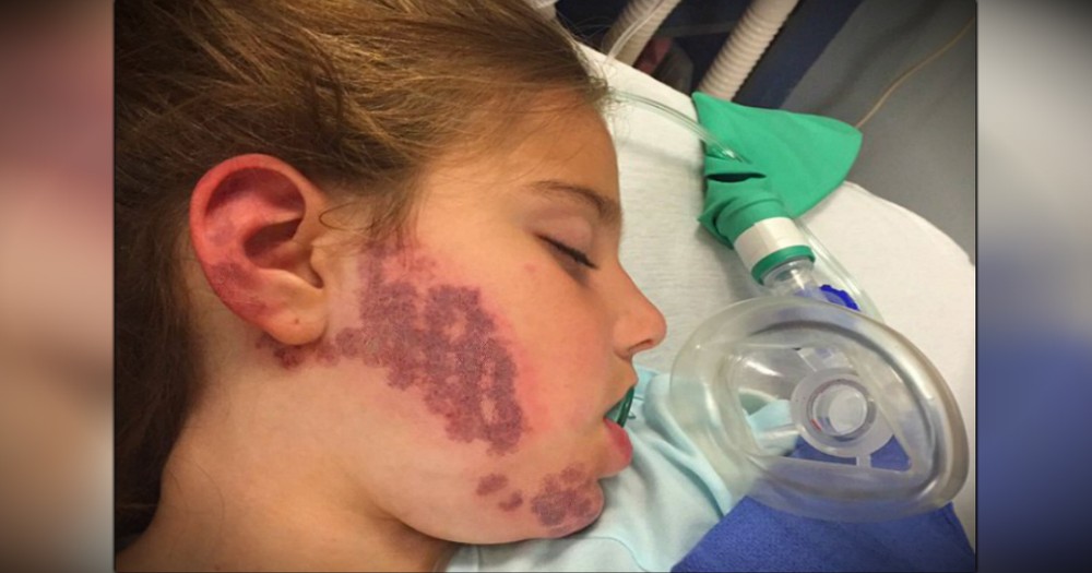 Beautiful 7-Year-Old Girl Embraces Her Birthmark