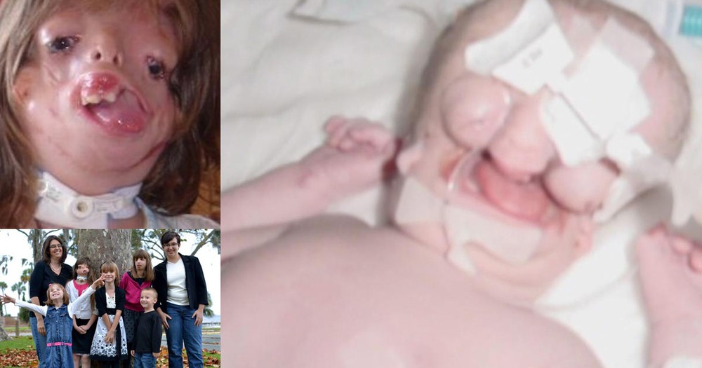 Girl Born Without A Face Surprised Doctors And Defied Internet Trolls