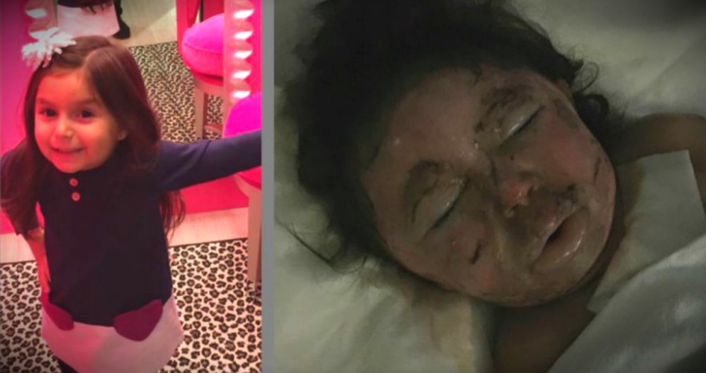 Mom's Warning After Pumpkin Explosion Disfigures Daughter's Face