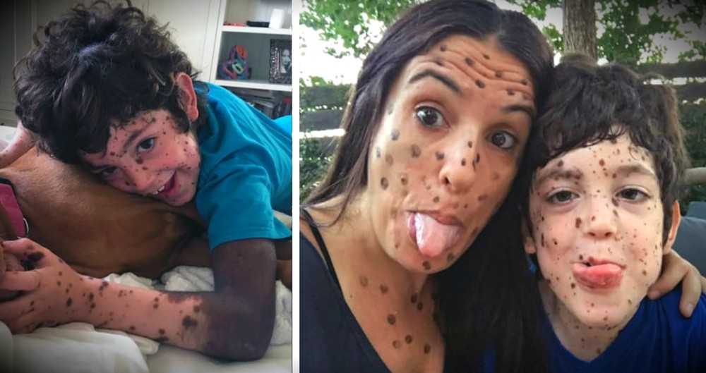 Rude Strangers Laughed At Moles Caused By Her Son's Rare Condition