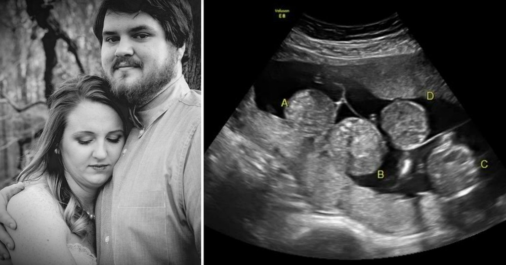 Woman Fearing Miscarriage 'Freaks Out' When Ultrasound Shows Rare Phenomenon