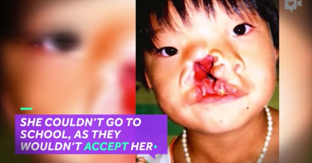 Young Girl's Massive Facial Deformity Fixed By Amazing Surgeons