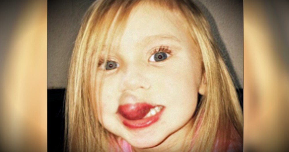 The Spot On Her Baby's Lip Grew Into A Debilitating, Kiwi-Sized Birthmark