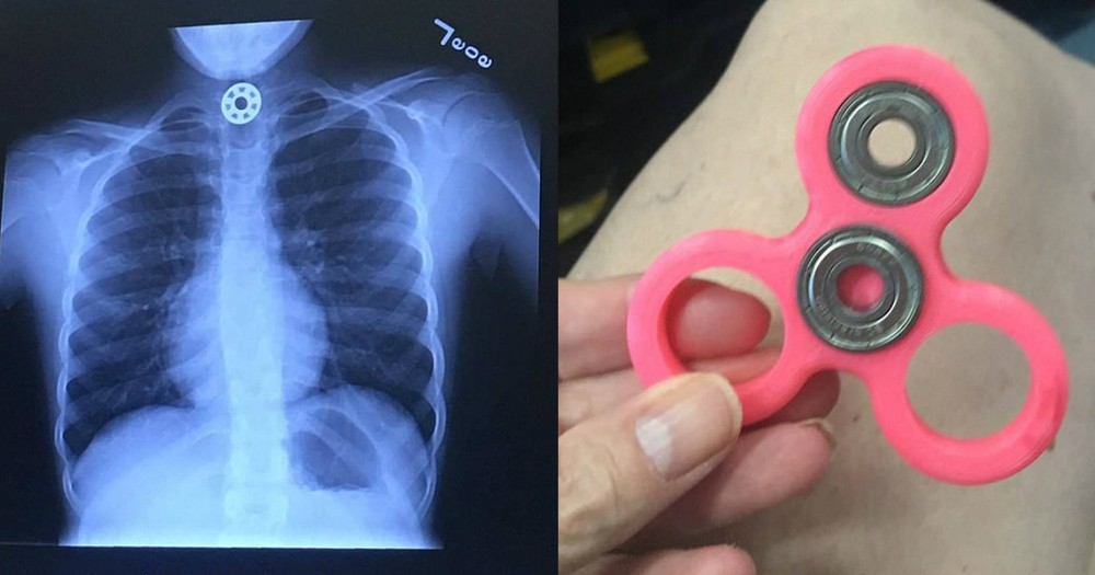 Mother Warns Others After Fidget Spinner Nearly Kills Her Daughter