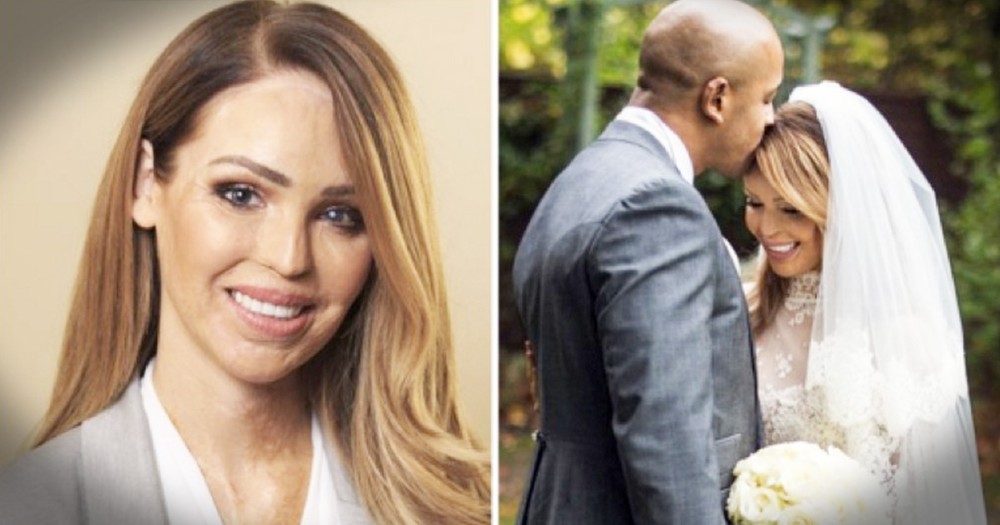 Acid Attack Survivor Katie Piper Is Moving On And Helping Others