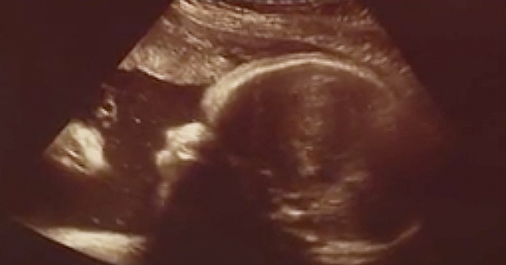 Couple Sees Jesus In Unborn Baby's Ultrasound Picture