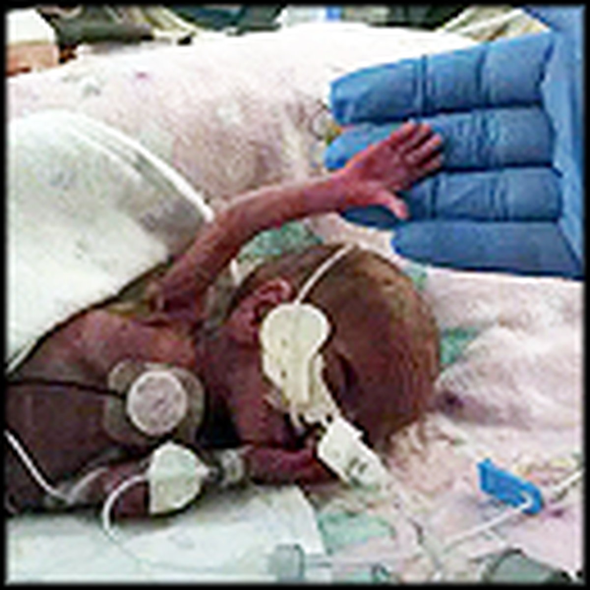 God Saves a 14 Ounce Baby Right Before Your Eyes - a True Miracle Video