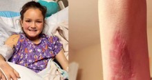 Mom Shares Terrifying Discovery That 'Pinch' on 9-Year-Old's Arm Was Brown Recluse Spider Bite
