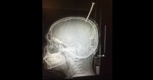 Freak Accident Leaves Boy With Screw In Skull 'A Millimeter Away' From Death