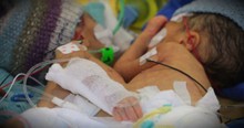 8-Day-Old Conjoined Twins Are Youngest Ever To Be Separated