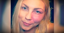 Bullied For Her Birthmark, This Actress Says To "Love Your Flaws"