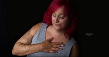 Bullied Burn Victim Hated Her 'Crocodile' Skin For Years, Then Her Daughter Changed Everything