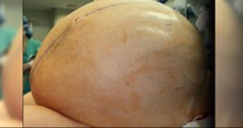 Doctors Race To Remove Enormous 132-Pound Tumor From Desperate Woman