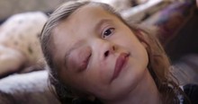 Sweet 10-Year-Old Girl with Rare Facial Tumor Ignores Those Who Laugh And Inspires Us All