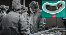 Man Ignored Pain for Years But Then Has Over 4,000 Gallstones Removed In Surgery