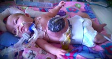 Baby With A Rare Birth Defect Gets Abandoned By Her Family And So Her Nurse Adopted Her