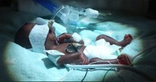 Smallest Baby Born Early Weighing 10 Ounces Goes Home Healthy