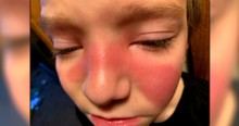 Parents Use Social Media To Warn Others of Strep in The Sinuses