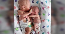 Baby Girl Defies Expectations And Survives To Cuddle Her Twin Brother In Sweet Photo