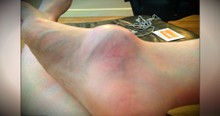 Woman Who Ignored Bump On Her Foot For 12 Years Warns Others