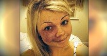 Woman With Birthmark Uses No Make-Up Selfie To Silence Bullies