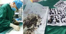 Woman Skipped Breakfast For Years Until Doctors Had To Remove 200 Gallstones