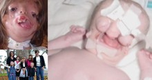 Girl Born Without A Face Surprised Doctors And Defied Internet Trolls