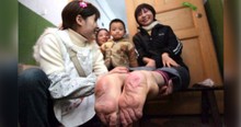 Woman Born With Backward Feet Has Positive Outlook On Life