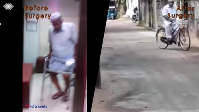 knee Replacement before and after Surgery