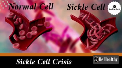 Sickle Cell Disease : SCD