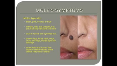 Mole Surgery In Lucknow