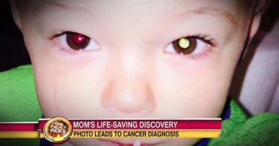 Photo On Facebook Alerts Mom About Her Son's Eye Cancer