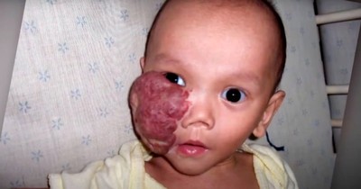 Parents Make Heartbreaking Decision to Give up Baby with Facial Tumor, Then Reunite Years Later