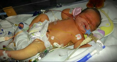 Miracle Baby Baffles Doctors When She Was Born With More Water In Her Body Than Blood