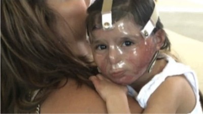 Mom's Warning After Pumpkin Explosion Disfigures Daughter's Face