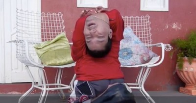Man Born With Upside Down Head Inspires Millions