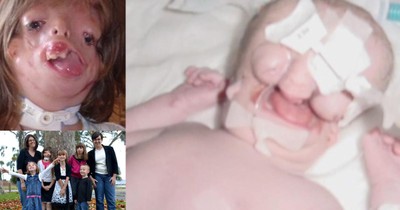 Girl Born Without A Face Surprised Doctors And Defied Internet Trolls