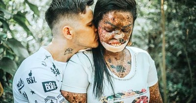 Woman with Incurable Skin Disease Trusted God To Send Her A Man Who Saw With His Heart