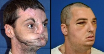 After A Tragic Accident, This Man Wanted To Take His Own Life. Until God Gave Him A Purpose, And A New Face!