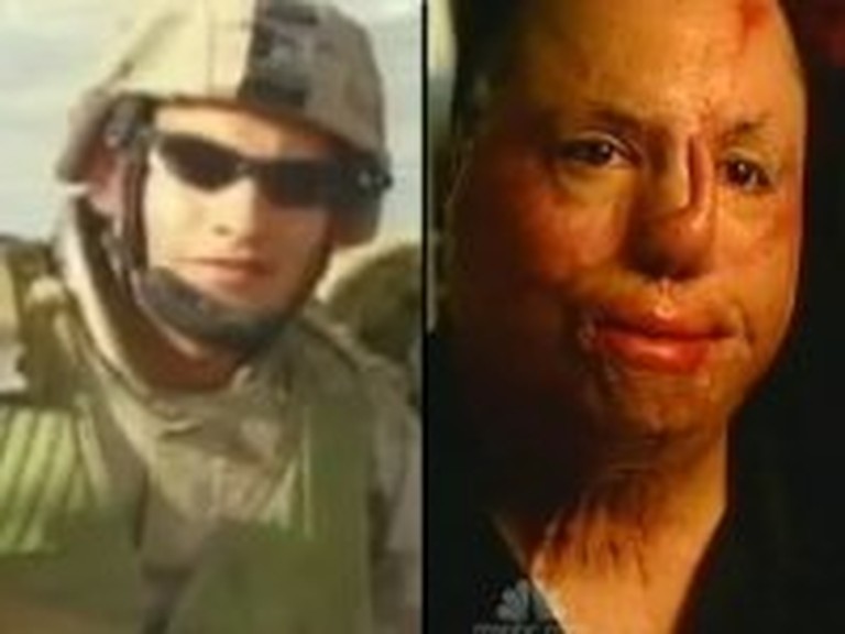 Severely Burned Soldier Tells his Unforgettable Story