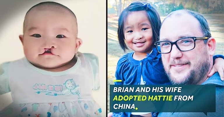 Man Adopts A Baby With Cleft Lip Just Like Him