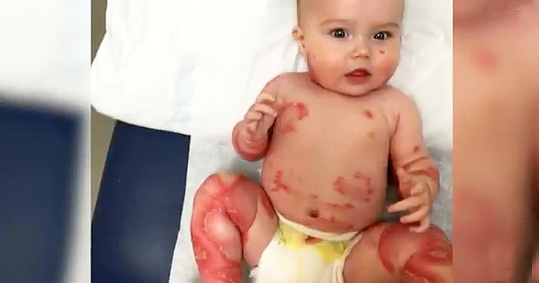 Mother Kisses Baby With Skin Disease For A Special Reason