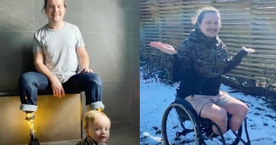 Dad Forced To Make Difficult Decision To Lose His Legs But Says It Gave Him Back His Life