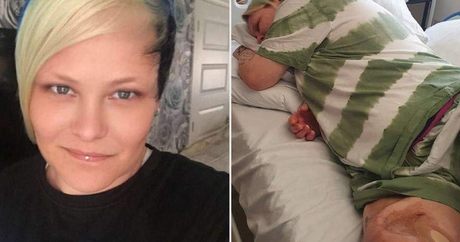 Scratch on Mom's Leg Gets Infected, and After 55 Surgeries, She's Begging Doctors to Amputate