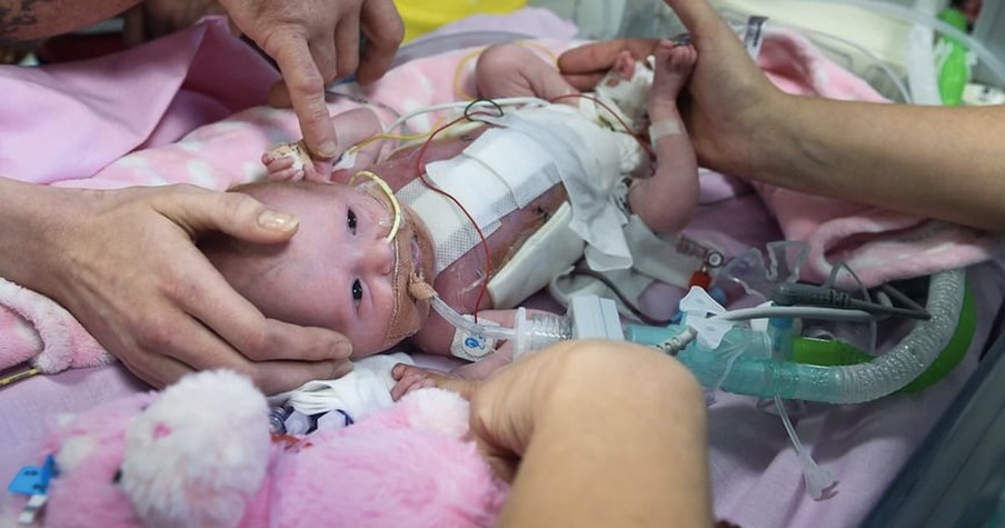 Parent's Celebrating A 'Miracle Baby' Born With Heart Outside Her Body